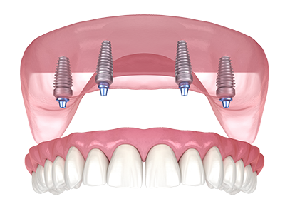 4-6-Implant-Retained-Overdenture