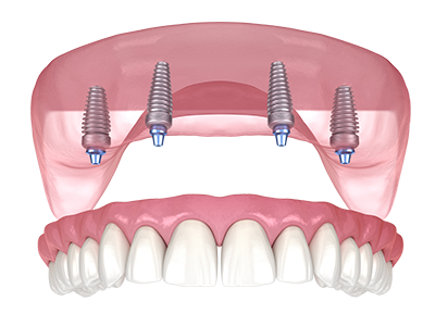 4-6-Implant-Retained-Overdenture