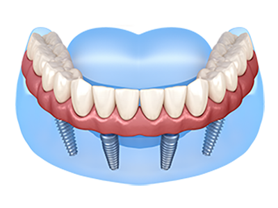 All-On-4-Dental-Implants---Single-Arch