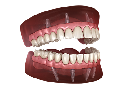 Permanent-Zirconia-Teeth-Double-Arch